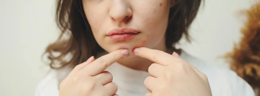 Pimple popping în siguranță – cum să scapi de coșuri fără a-ți afecta pielea