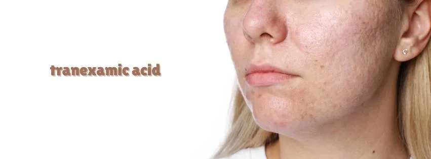 Acidul tranexamic în skincare: ce este și cum te ajută să reduci petele pigmentare
